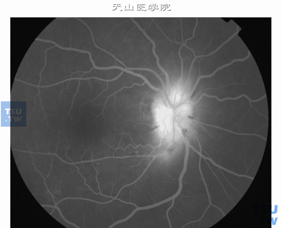 糖尿病性视神经缺血性视神经病变