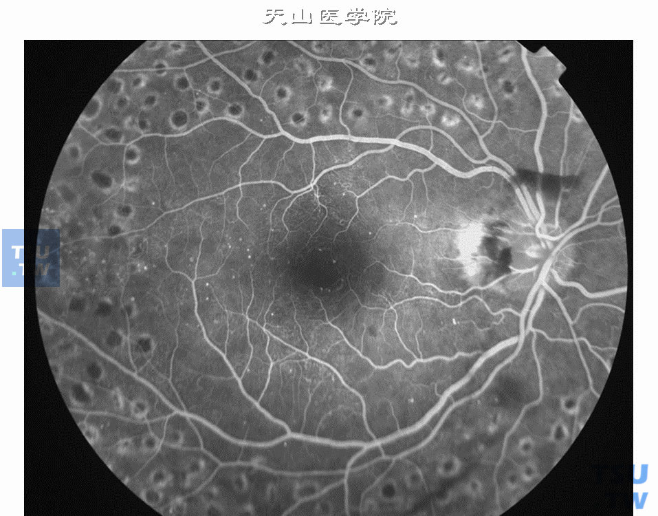 增生性糖尿病视网膜病变全视网膜光凝治疗后荧光造影像。视盘上方和周围视网膜小片出血，视盘上方小片视网膜前出血。出血为遮挡荧光，黄斑区很多强荧光点为微血管瘤