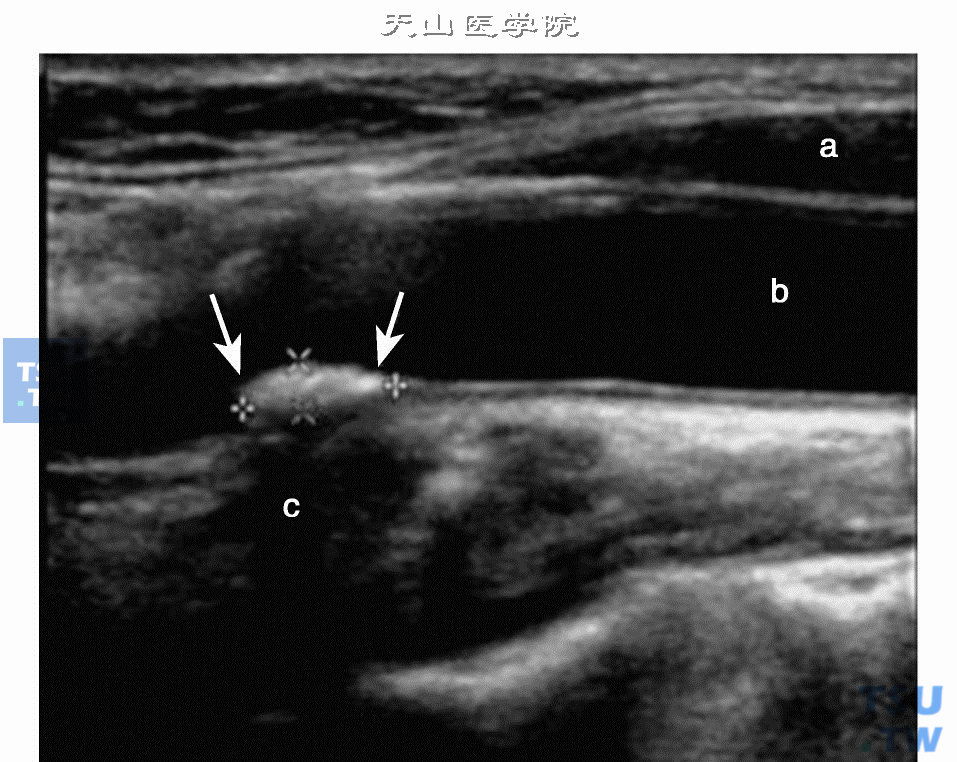 颈动脉2D：a示软组织低回声；b示血管腔无回声；箭头示斑块强回声；c示斑块后方声影