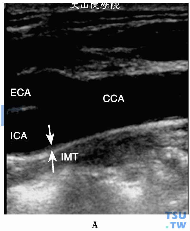 颈动脉IMT（箭头）