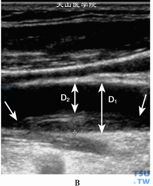 颈动脉狭窄直径（D1、D2，双向箭头）测量，单向箭头示颈动脉斑块