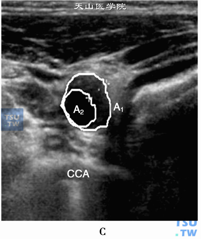 颈动脉狭窄面积（A1、A2）测量；ECA：颈外动脉；ICA：颈内动脉；CCA：颈总动脉