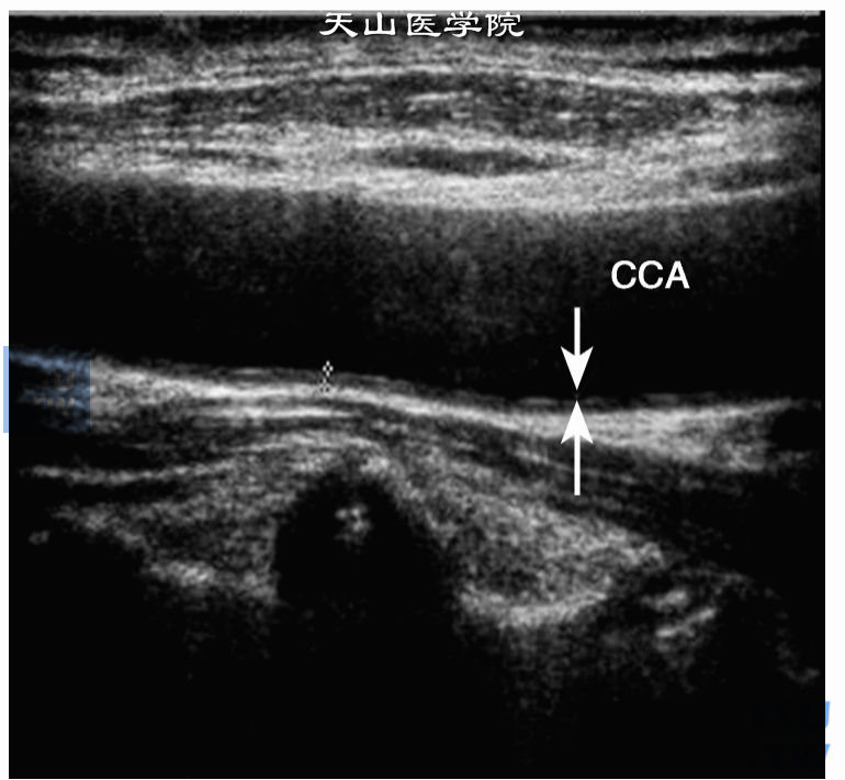  颈总动脉IMT测量（箭头）