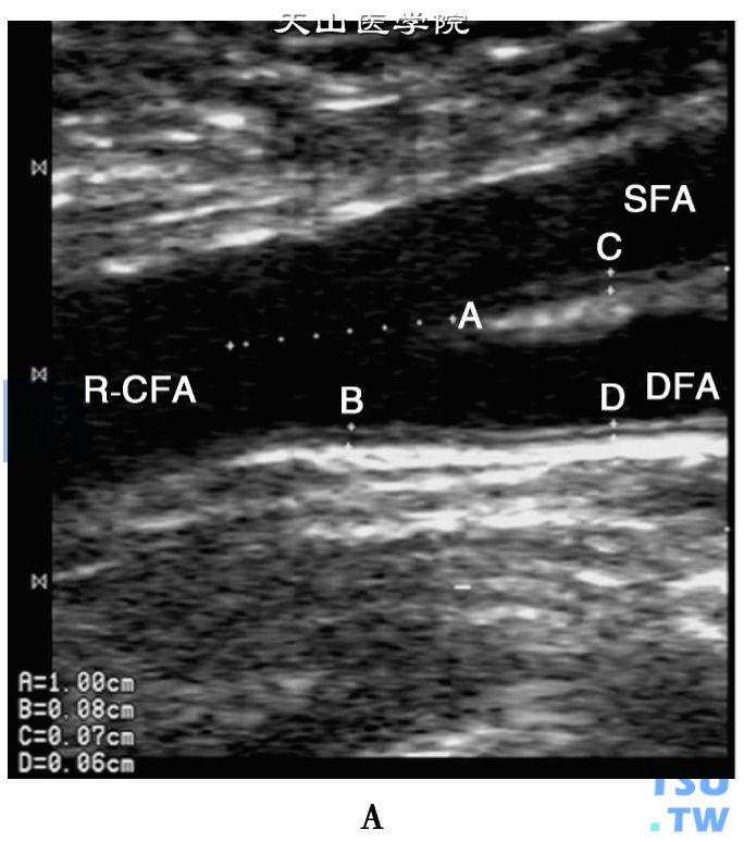 正常下肢动脉二位超声：右下肢股总动脉（R-CFA）、股浅动脉（SFA）、股深动脉（DFA），（图中B、C、D分别为其IMT，均＜1. 0mm）