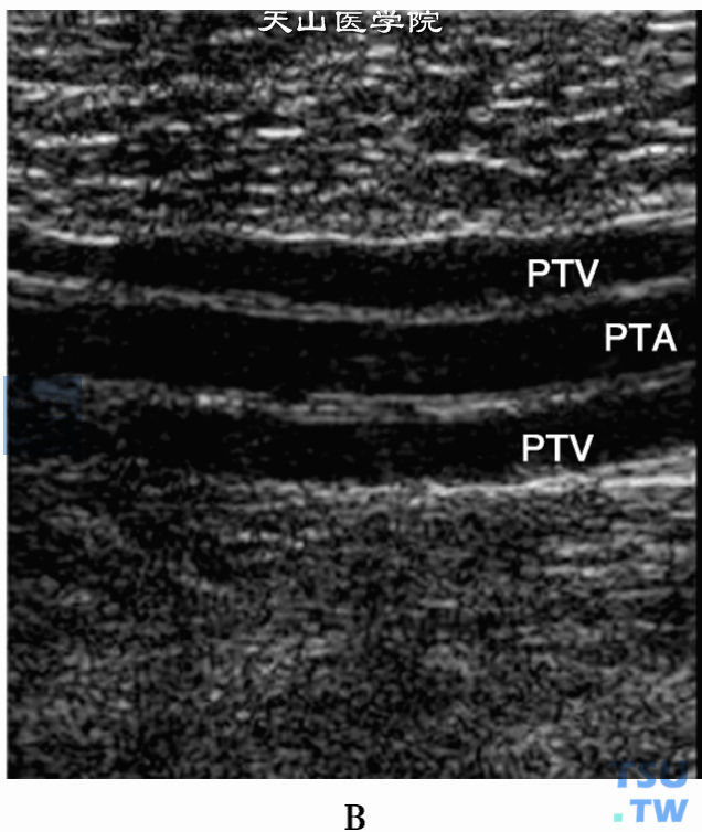 正常下肢动脉二位超声：右下肢胫后动脉（PTA）和其伴行的2条胫后静脉（PTV）