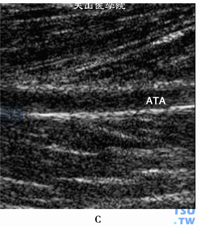 正常下肢动脉二位超声：右下肢胫前动脉（ATA）