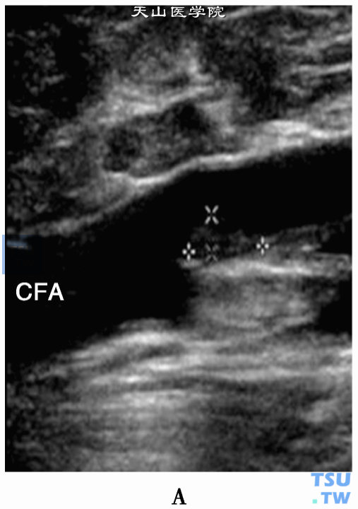 下肢动脉粥样硬化斑块2D二位超声：股动脉（CFA）等回声斑块（测量游标）