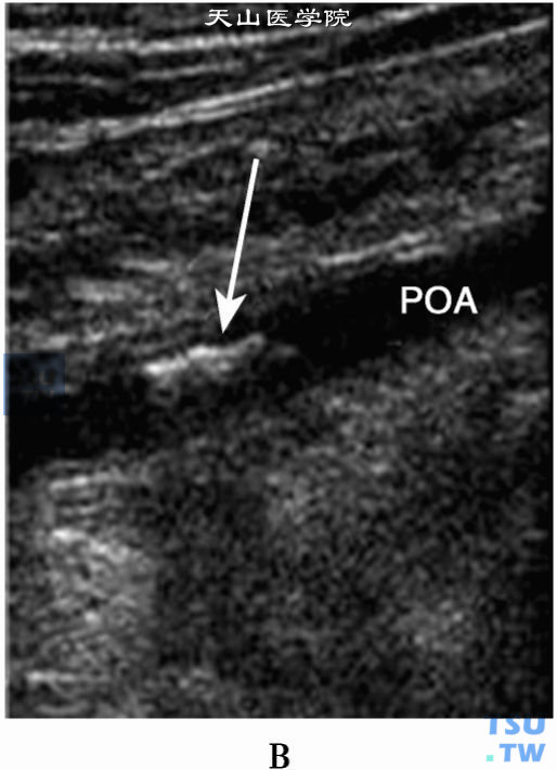 下肢动脉粥样硬化斑块2D二位超声：腘动脉（POA）前壁强回声斑块（箭头）