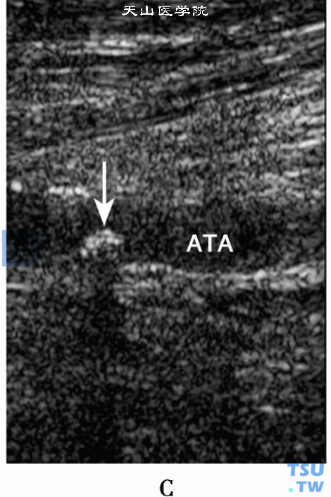 下肢动脉粥样硬化斑块2D二位超声：胫前动脉（ATA）后壁混合回声斑块（箭头）