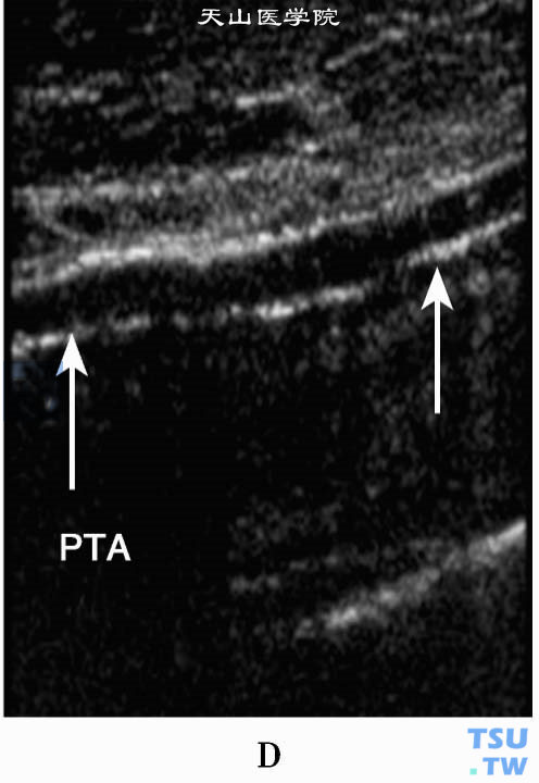 下肢动脉粥样硬化斑块2D二位超声：胫后动脉（PTA）前、后壁弥漫性条状强回声小斑块（箭头）