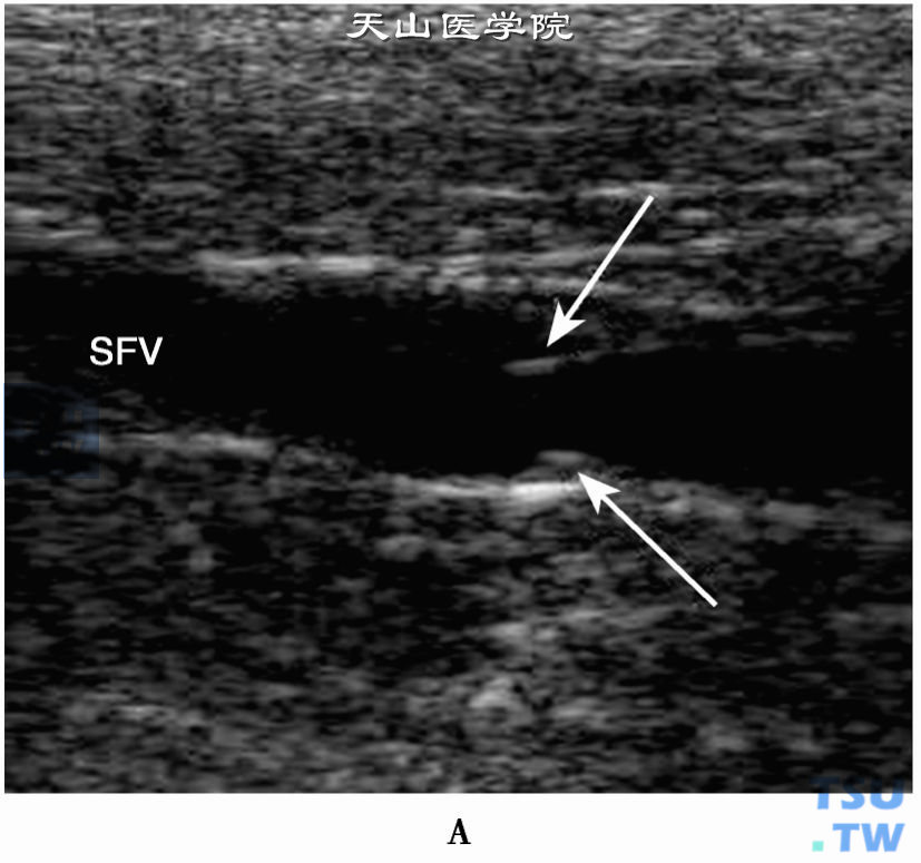 正常下肢静脉2D，A：股浅静脉（SFV）和静脉瓣（箭头）