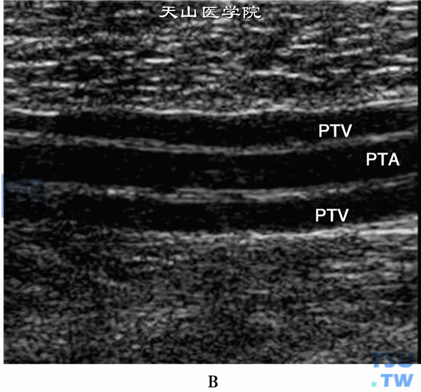 正常下肢静脉2D，B：胫后静脉（PTV）和胫后动脉（PTA）