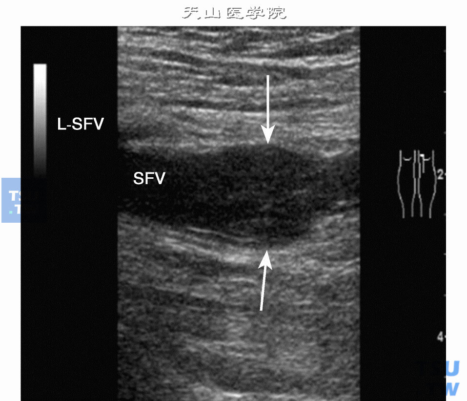  股浅静脉（SFV）急性血栓2D显示管腔明显增宽和管腔内低回声（箭头）