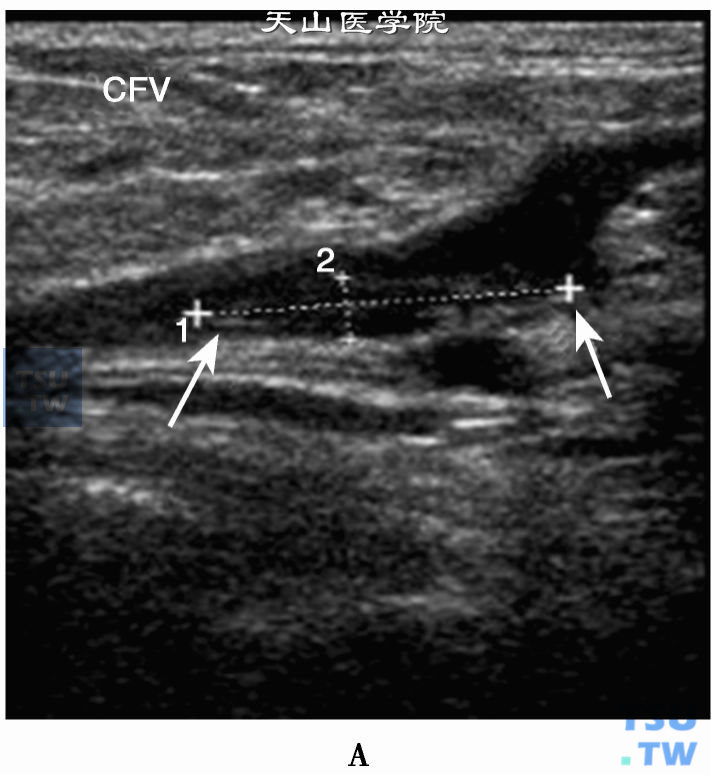 下肢股静脉慢性血栓二位超声：股总静脉（CFV）混合回声血栓（箭头）