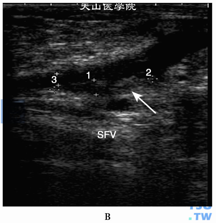 下肢股静脉慢性血栓二位超声：股浅静脉不均质中等回声血栓（箭头）
