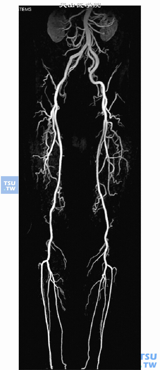  正常成人下肢CE-MRA图像，自肾动脉以下腹主动脉、髂总动脉、髂内外动脉、腘动脉、胫前后动脉及腓动脉走行及官腔可以清楚地被显示