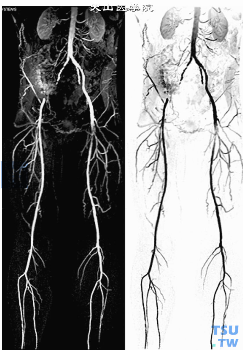  糖尿病患者CE-MRA，右侧髂总动脉粗细不均匀，右侧髂内动脉明显狭窄，同时可以看到左侧股动脉局限性狭窄