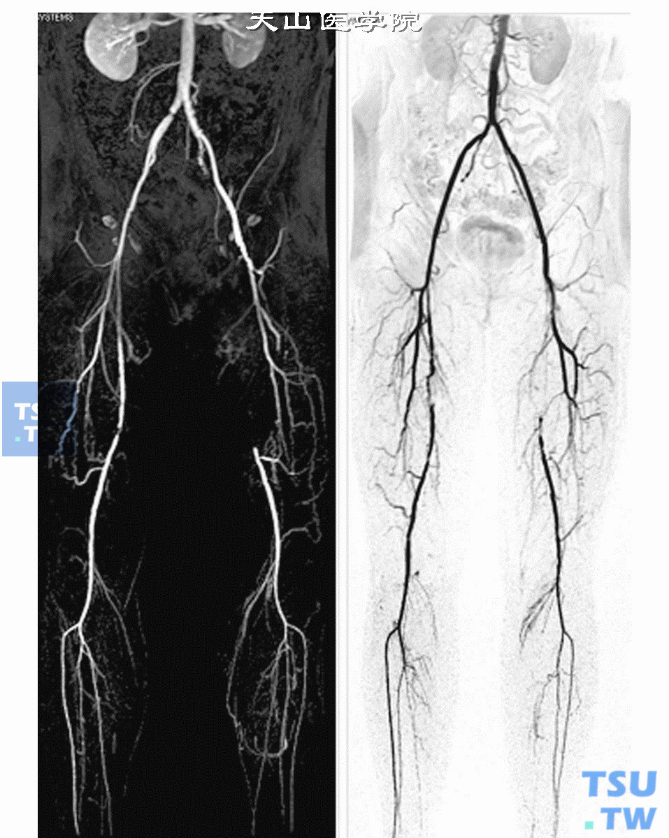  糖尿病患者CE-MRA，两侧股动脉粗细不均匀，左侧股动脉下段完全阻塞，可见大量侧支血管形成