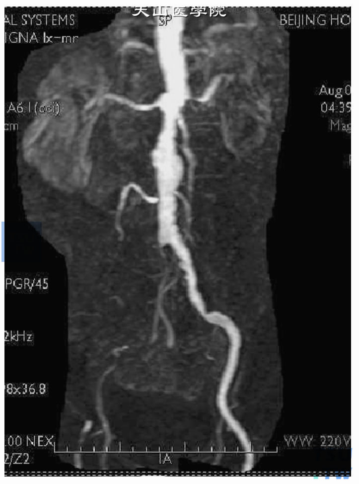  糖尿病患者CE-MRA，左侧肾动脉局限性狭窄，腹主动脉及左侧髂动脉粗细不均匀，右侧髂总动脉明显变细