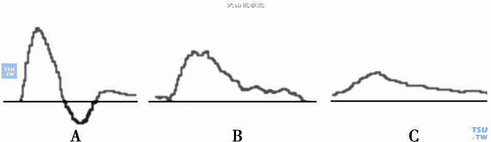 多普勒描记的各种动脉波形，A：正常动脉三相波形；B：动脉中度狭窄时第1相波增高，第2、3相波变小；C：严重狭窄时2、3相波消失，第1相波变成单相波，波峰圆钝