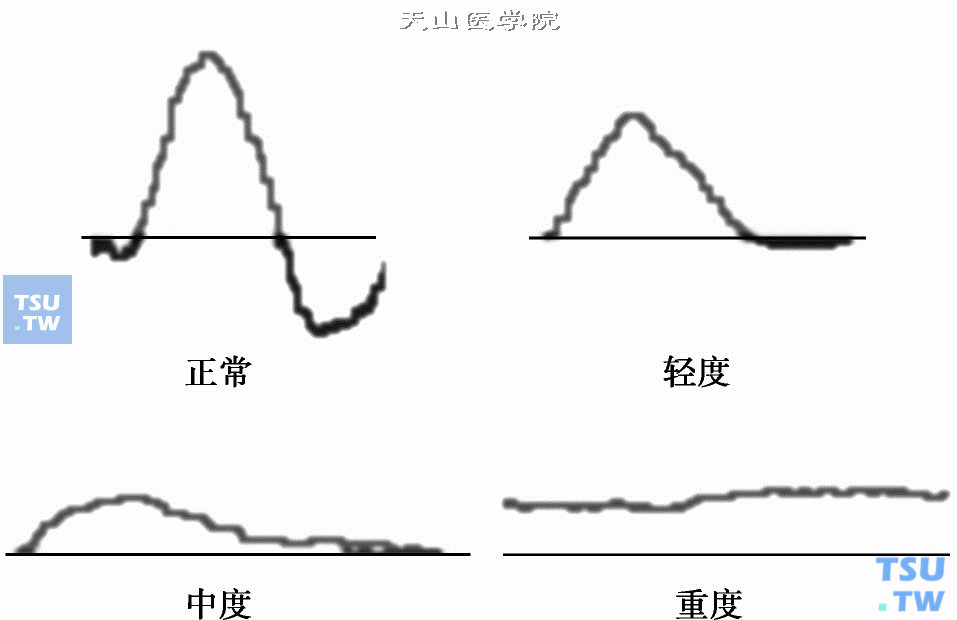 多普勒无创血管检查：肢体体积描记法