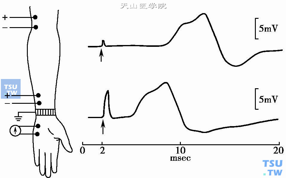  上图，正常人尺神经运动传导速度测定图：在肘部和腕部分别刺激尺神经，从小指外展肌上记录复合肌肉动作电位。测量出的两刺激点阴极间的距离，再除以两点之间潜伏期之差，便得出从肘部到腕部的运动传导速度（引自Lenman，1977）