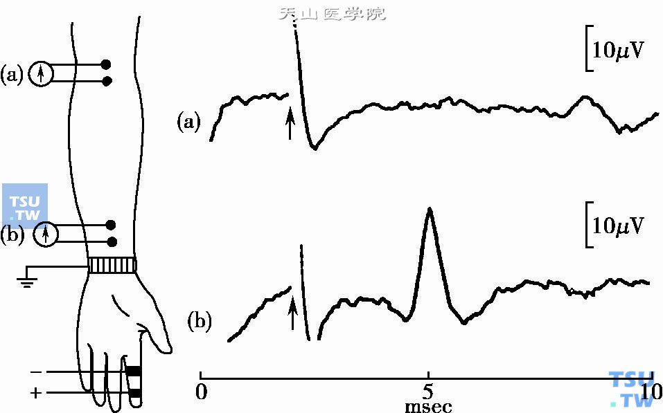 正常人正中神经感觉传导速度测定图：用指环电极刺激示指正中神经的末梢，分别从肘部和腕部记录出感觉神经动作电位。注意腕部和肘部记录到的图形略有差异（引自Lenman，1977）