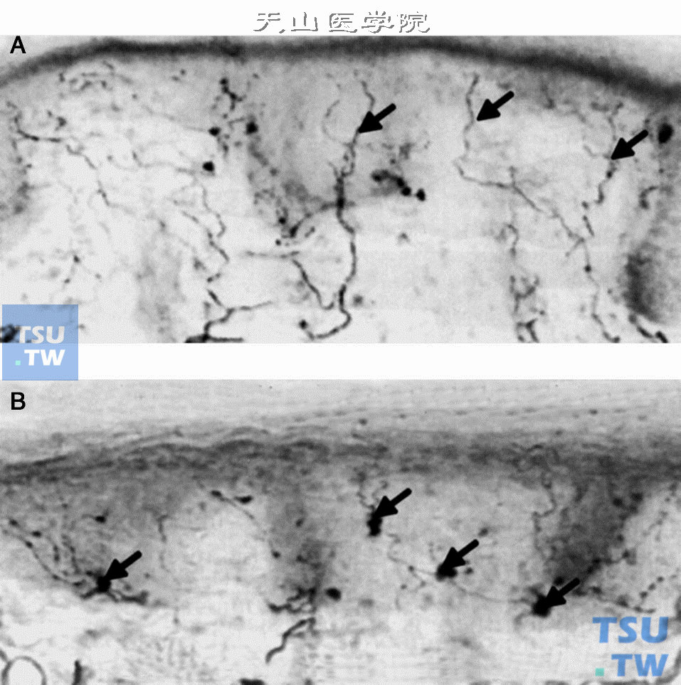  皮肤活检：A.正常表皮内神经纤维；B.糖尿病患者，神经纤维减少并有肿胀（引自：Diabetic neuropathies. Med Clin N Am，2004，88：947）