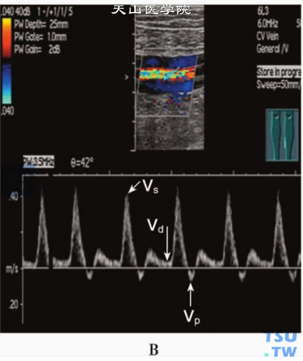 肢体动脉PW:Vs、Vd、Vp测量图