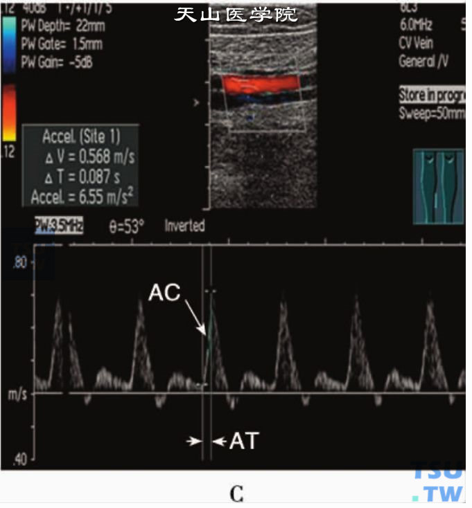 肢体动脉PW：AC、AT测量图