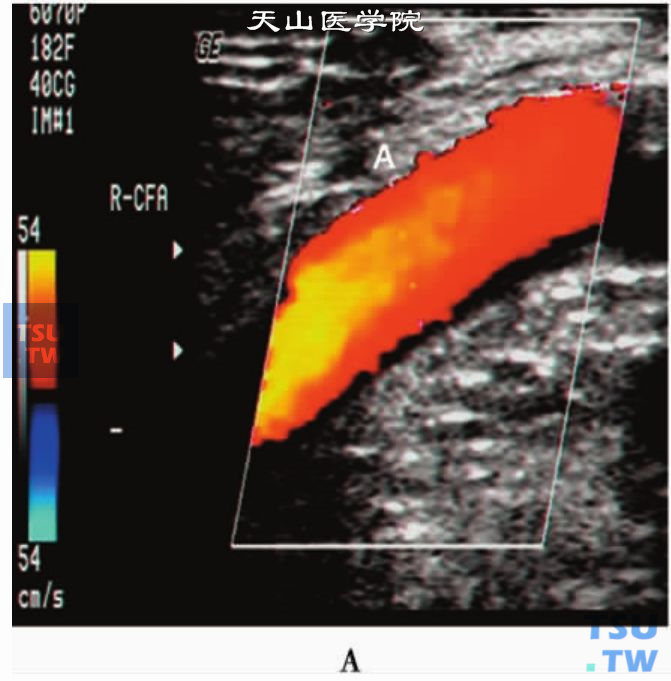 动脉血管CDFI：正常股动脉层流血流