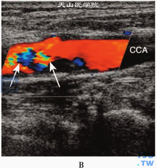 动脉血管CDFI：颈动脉狭窄后“五彩镶嵌”（箭头）湍流血流