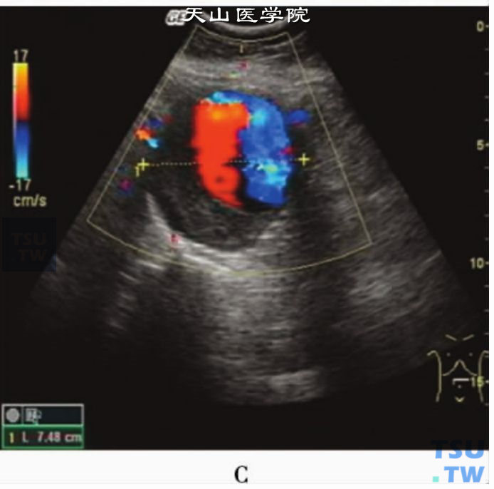 动脉血管CDFI：腹主动脉瘤涡流血流（同一段血管内同时显示红色和蓝色血流信号）
