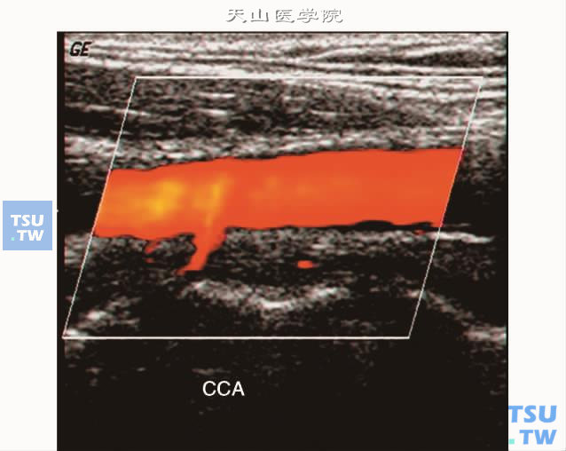  颈总动脉CDFI