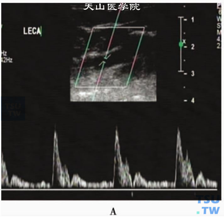 脉冲多普勒：正常颈外动脉