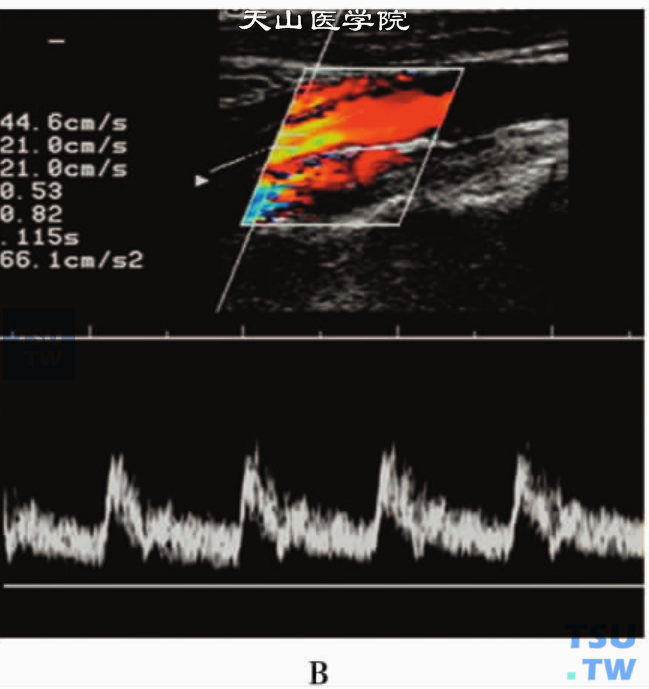 脉冲多普勒：颈内动脉（B）