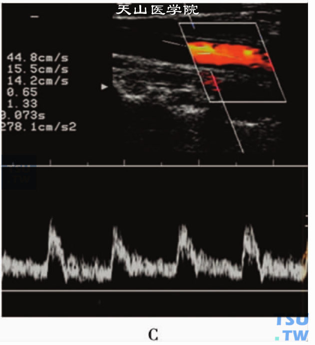 脉冲多普勒：颈总动脉（C）PW