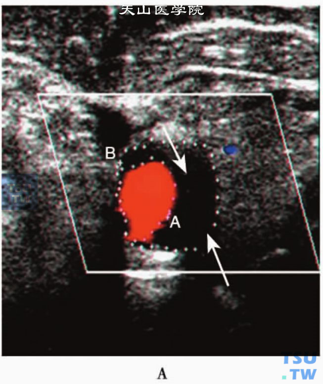 颈总动脉横切面示低回声软斑（箭头）
