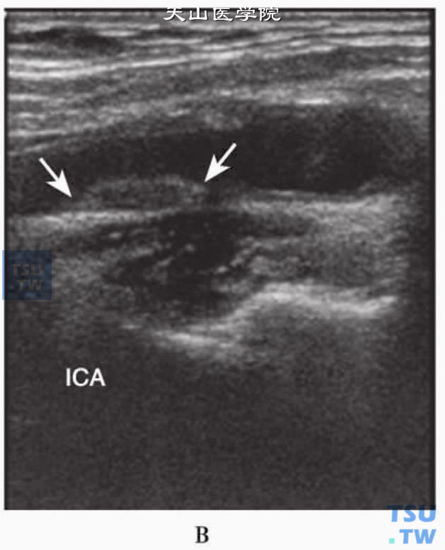 颈内动脉纵切面示等回声软斑（箭头）