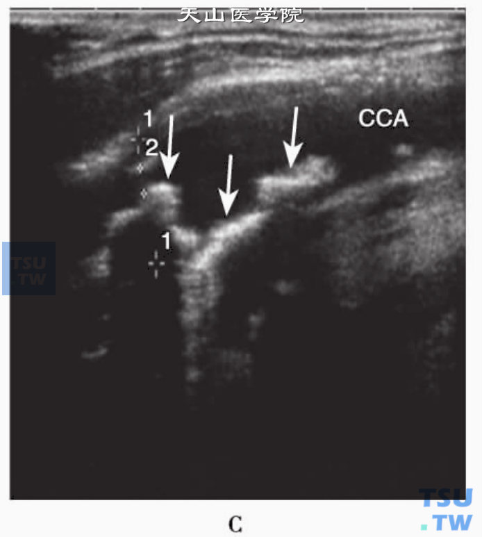 颈总动脉纵切面示多发强回声硬斑（箭头），部分硬斑后方伴声影