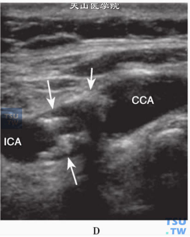 颈总动脉和颈内动脉交界处示混合回声斑块（箭头）