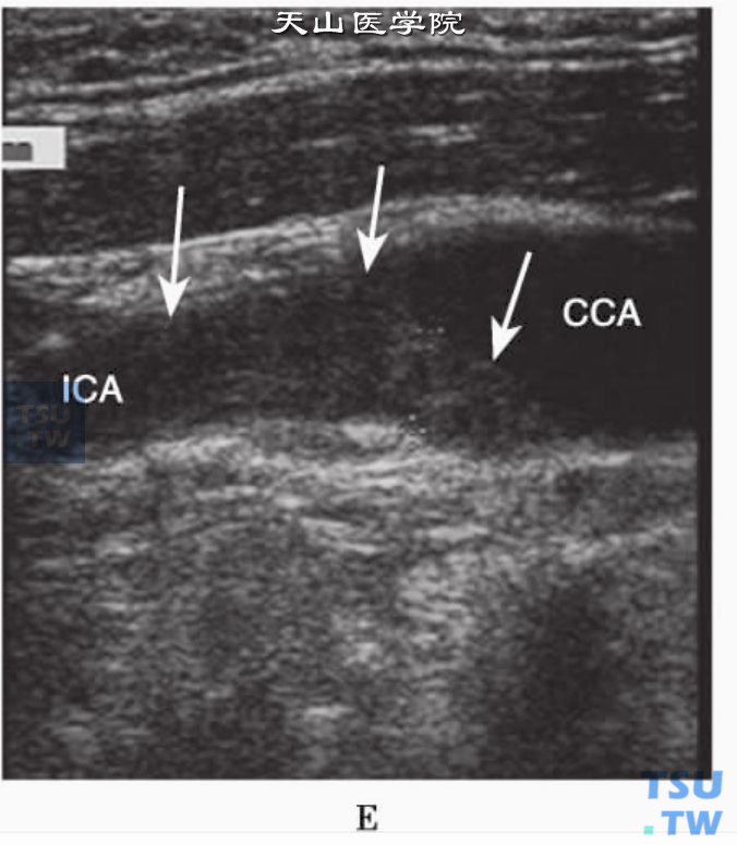 颈总动脉膨大处和颈内动脉近段充满较均质等回声示颈内动脉近段闭塞（箭头）