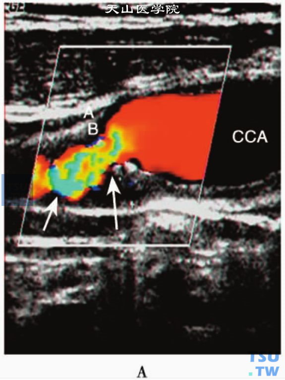 斑块致颈内动脉近端狭窄，狭窄出口处示“五彩镶嵌”血流信号（箭头）