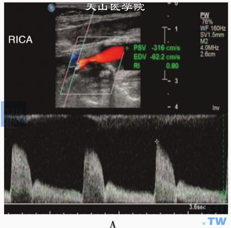 RICA狭窄出口处动脉峰值流速明显增高，Vs达316cm/s