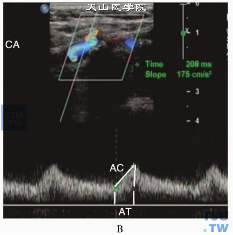 RICA狭窄远端动脉收缩早期加速度减低AC为175cm/s2，加速时间延长AT为0. 208秒