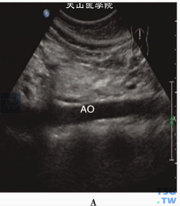 腹主动脉正常声像图：腹主动脉2D显示血管壁光滑，血管腔为无回声