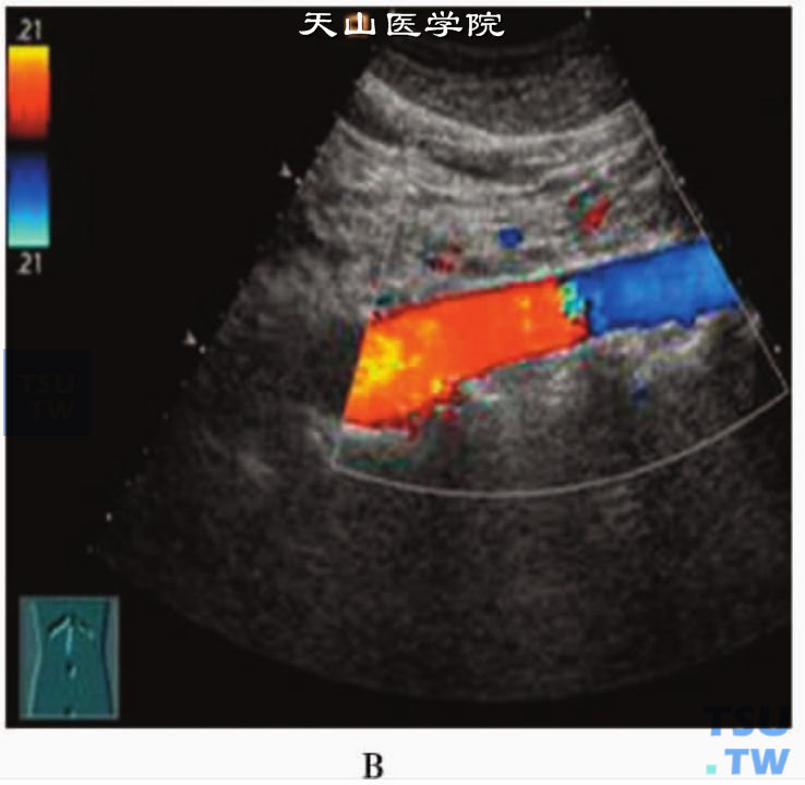 腹主动脉正常声像图：腹主动脉CDFI显示血管内层流血流（红、蓝颜色分别表示血流朝向和背离探头）