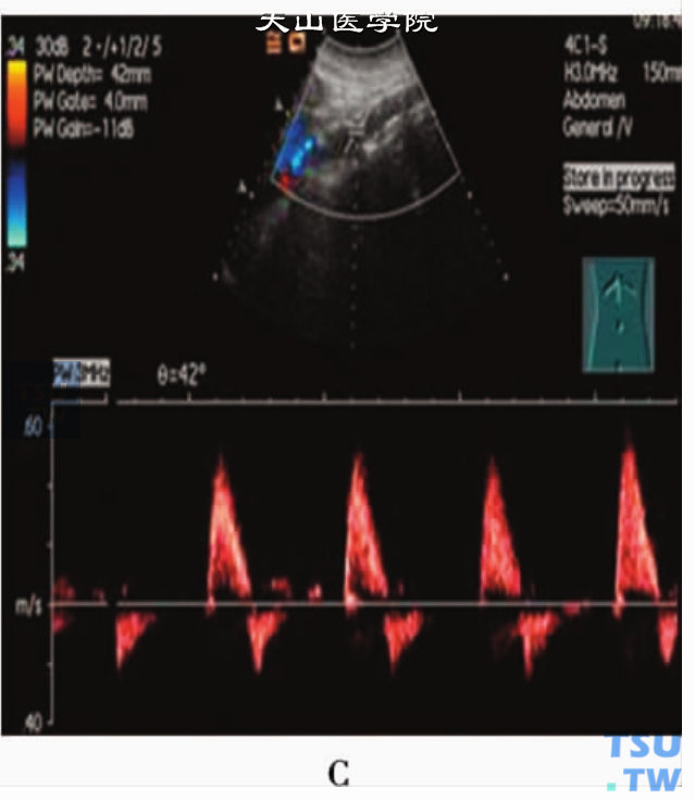腹主动脉正常声像图：腹主动脉PW显示血流频谱形态为“双相高阻”型