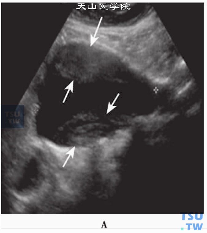 腹主动脉真性动脉瘤声像图：2D纵断面显示腹主动脉真性动脉瘤伴前、后壁附壁血栓（箭头）
