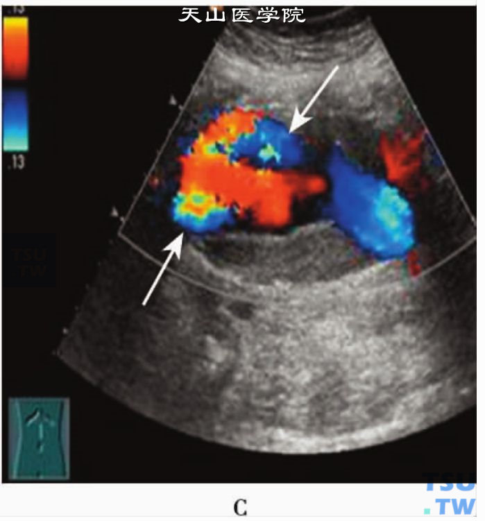腹主动脉真性动脉瘤声像图：CDFI纵断面显示腹主动脉真性动脉瘤内红、蓝相间涡流血流信号（箭头）